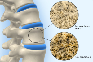 Cara Alami Mengobati Osteoporosis